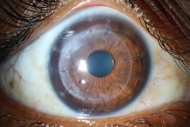 Descemet’s stripping endothelial keratoplasty (DSEK)