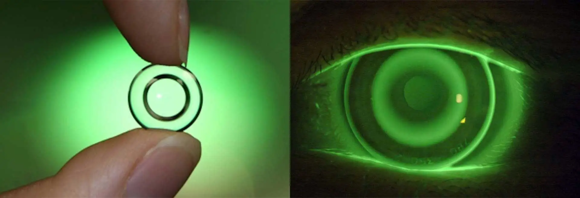 Orthokeratology Lenses