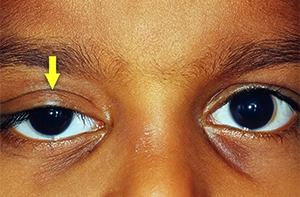 Droopy Eyelids