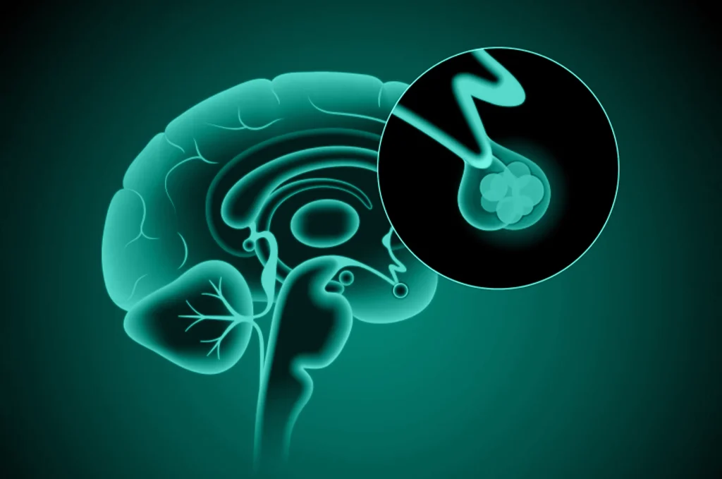 Intracranial Tumors