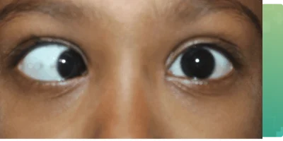 Squint eye problem